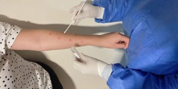 BCS: Confirma Salud Estatal un Caso de Viruela Símica no Grave