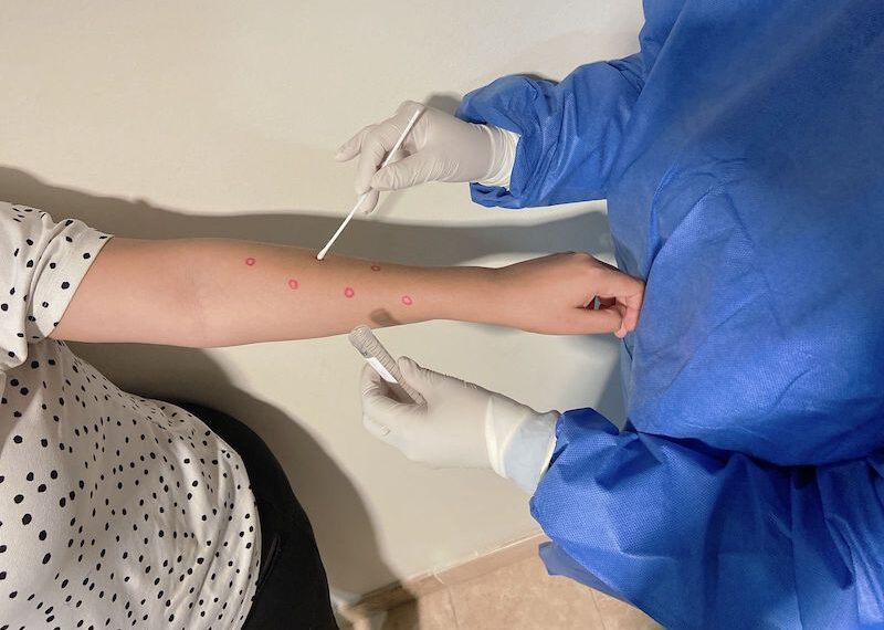 BCS: Confirma Salud Estatal un Caso de Viruela Símica no Grave